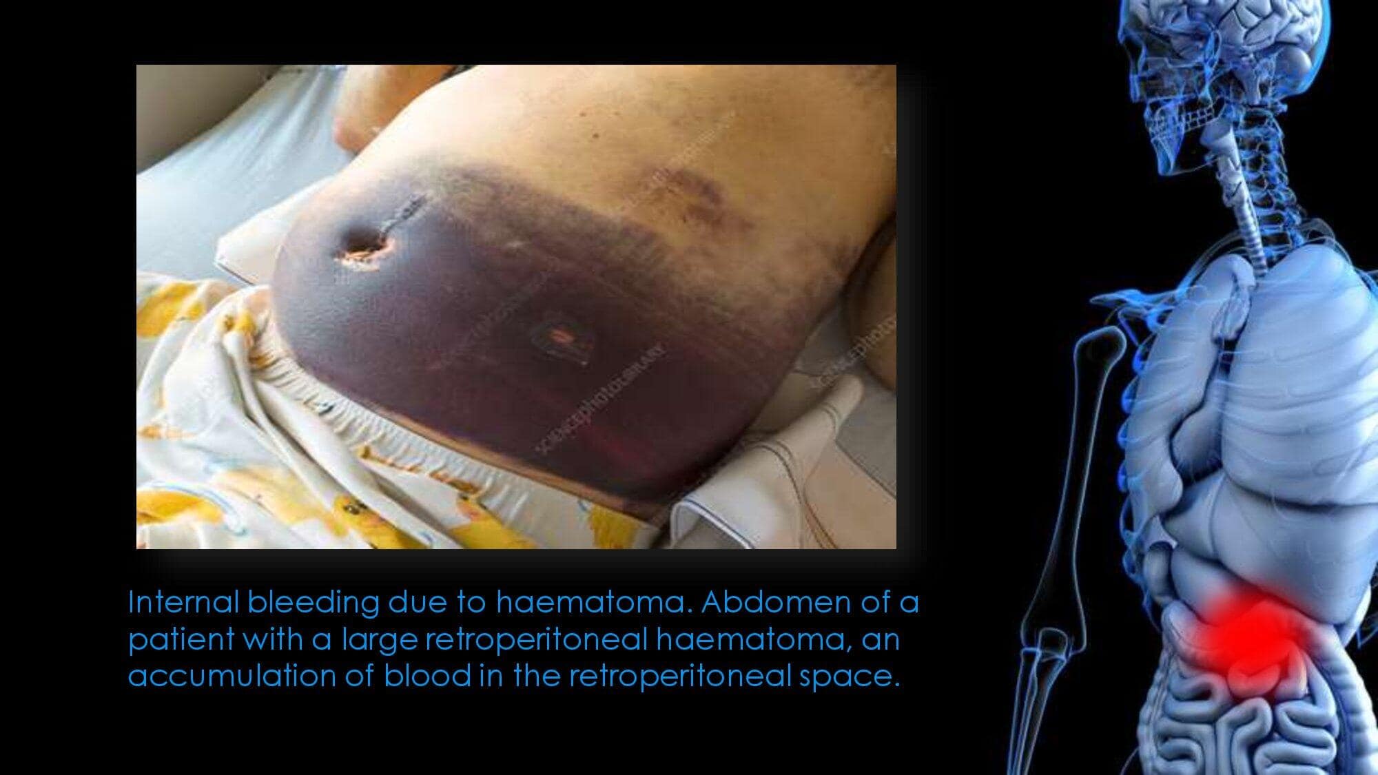 Abdomen Trauma. GRA.19E_0000006