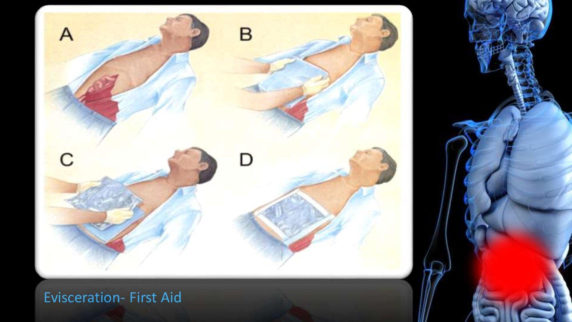 Abdomen Trauma. GRA.19E_0000012