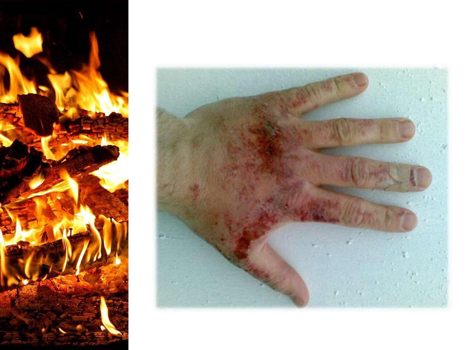DisasterMed-Burns.R.A_0000014